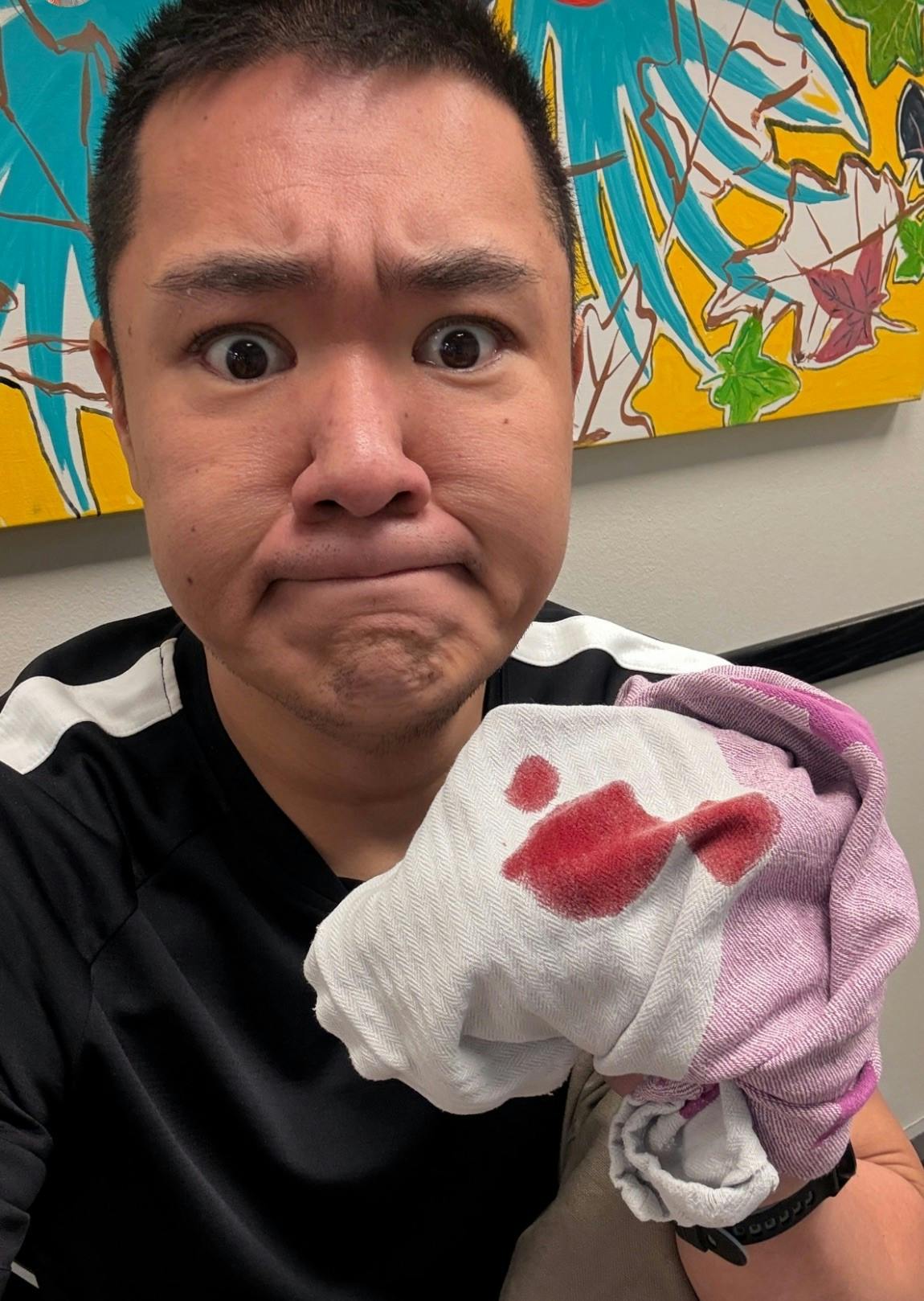 Micki Cheng med "hjemmelavet" forbinding på sin skadede finger.