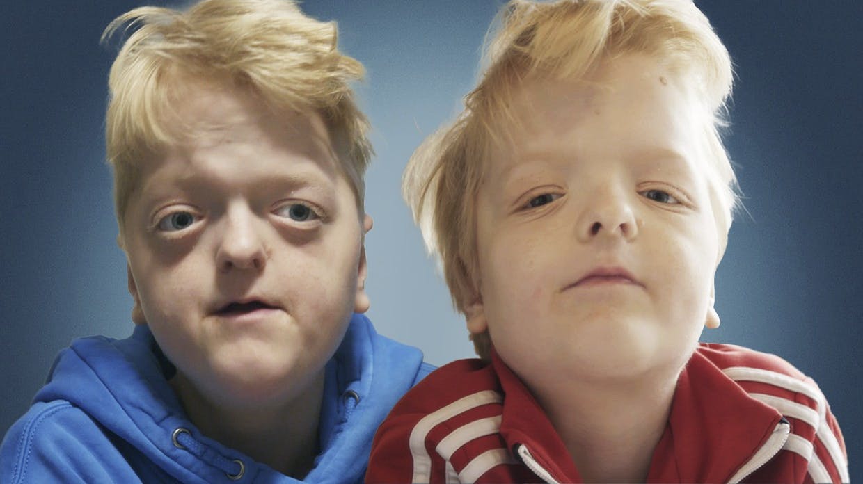 Bastian fra "De sjældne danskere" før og efter operationen. 