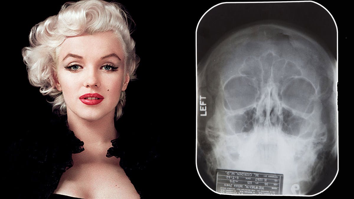 Marilyn Monroe med det netop frigivende røntgenbillede af hendes ansigt.