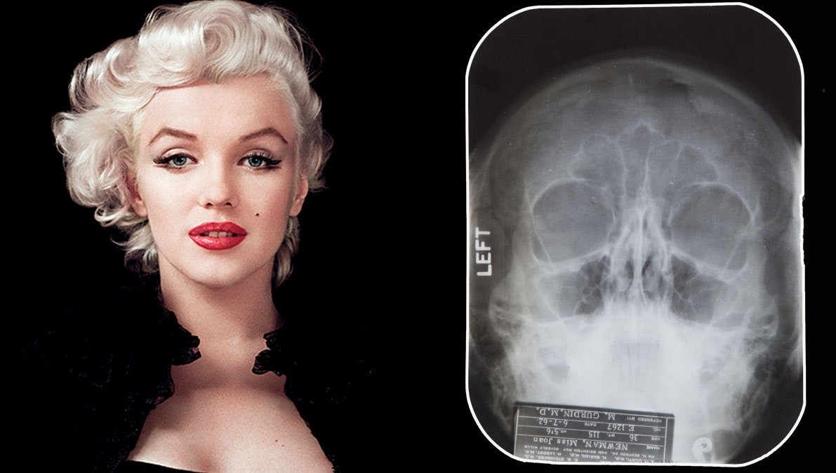 Marilyn Monroe med det netop frigivende røntgenbillede af hendes ansigt.